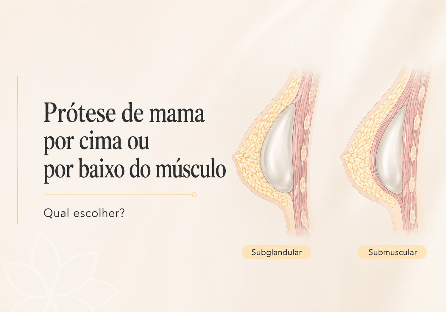 Prótese de mama por cima ou por baixo do músculo: qual escolher?