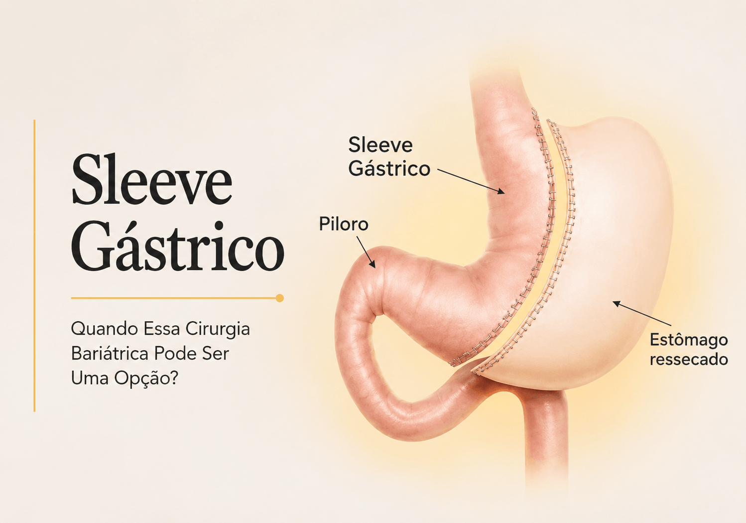 Sleeve Gástrico: Quando Essa Cirurgia Bariátrica Pode Ser Uma Opção?