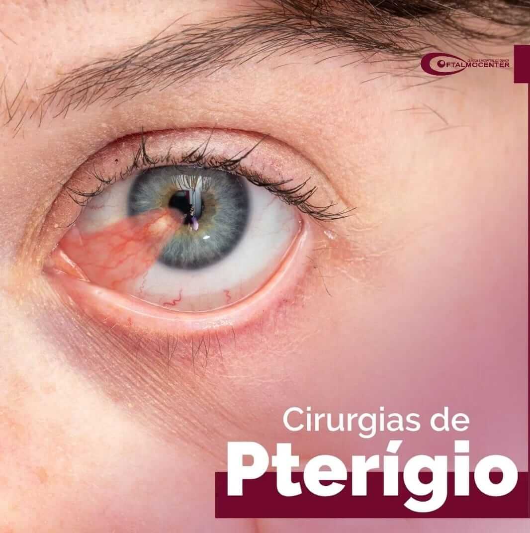 Cirurgias de Pterígio