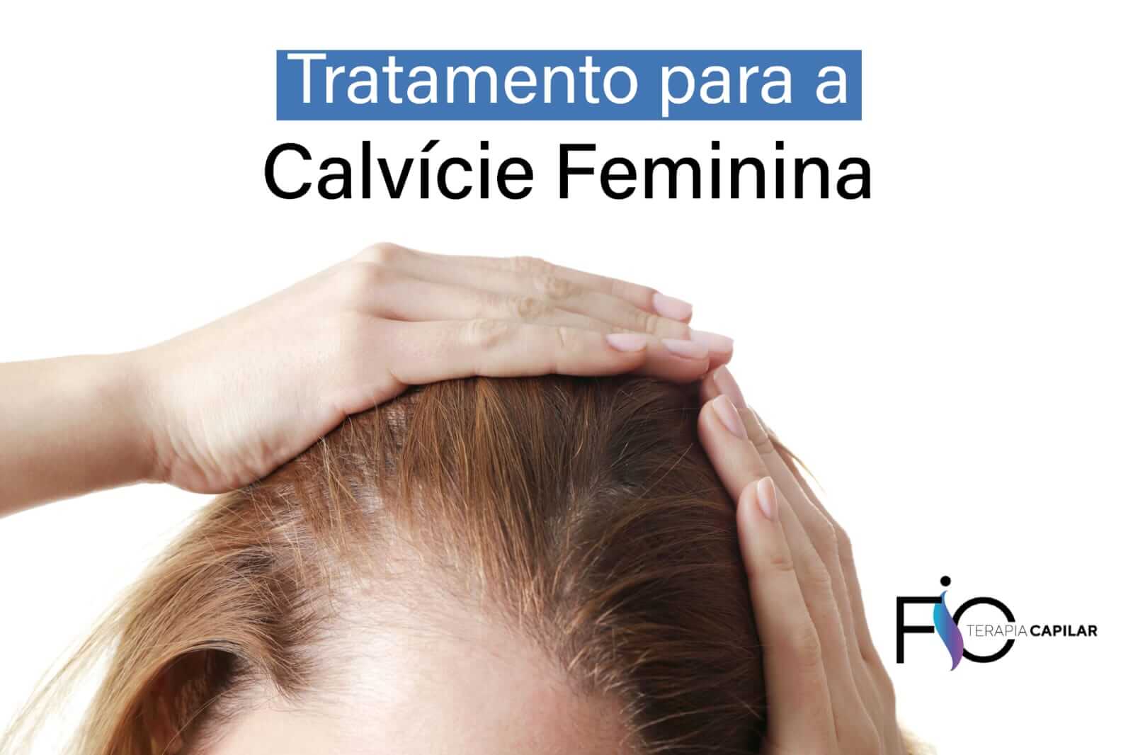 Tratamento para a Calvície Feminina