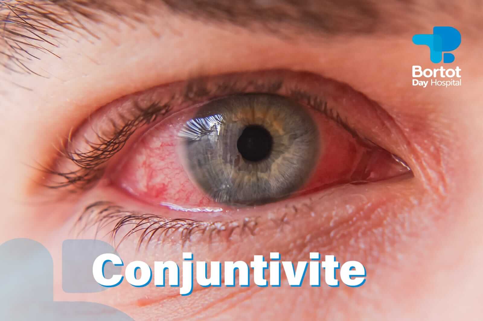 Conjuntivite