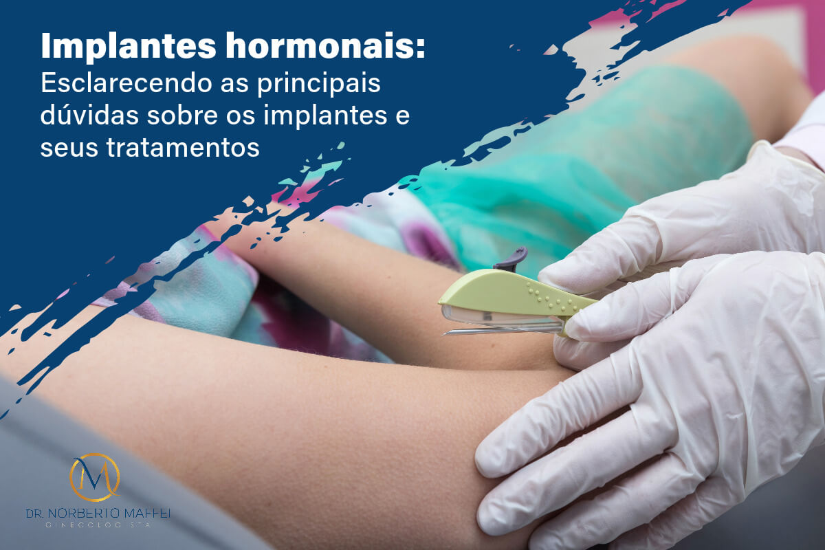 Implantes hormonais: Esclarecendo as principais dúvidas sobre os implantes e seus tratamentos