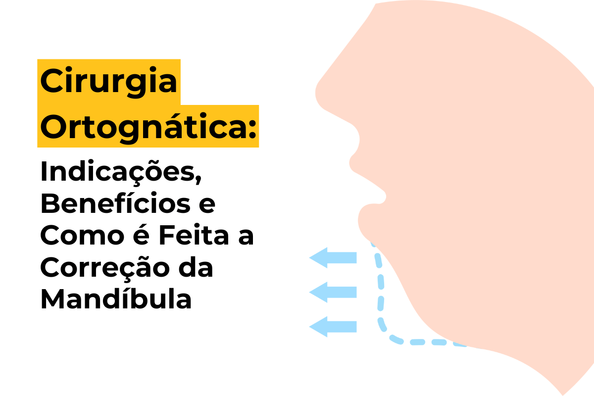 Cirurgia Ortognática em Maringá: Indicações, Benefícios e Como é Feita a Correção da Mandíbula