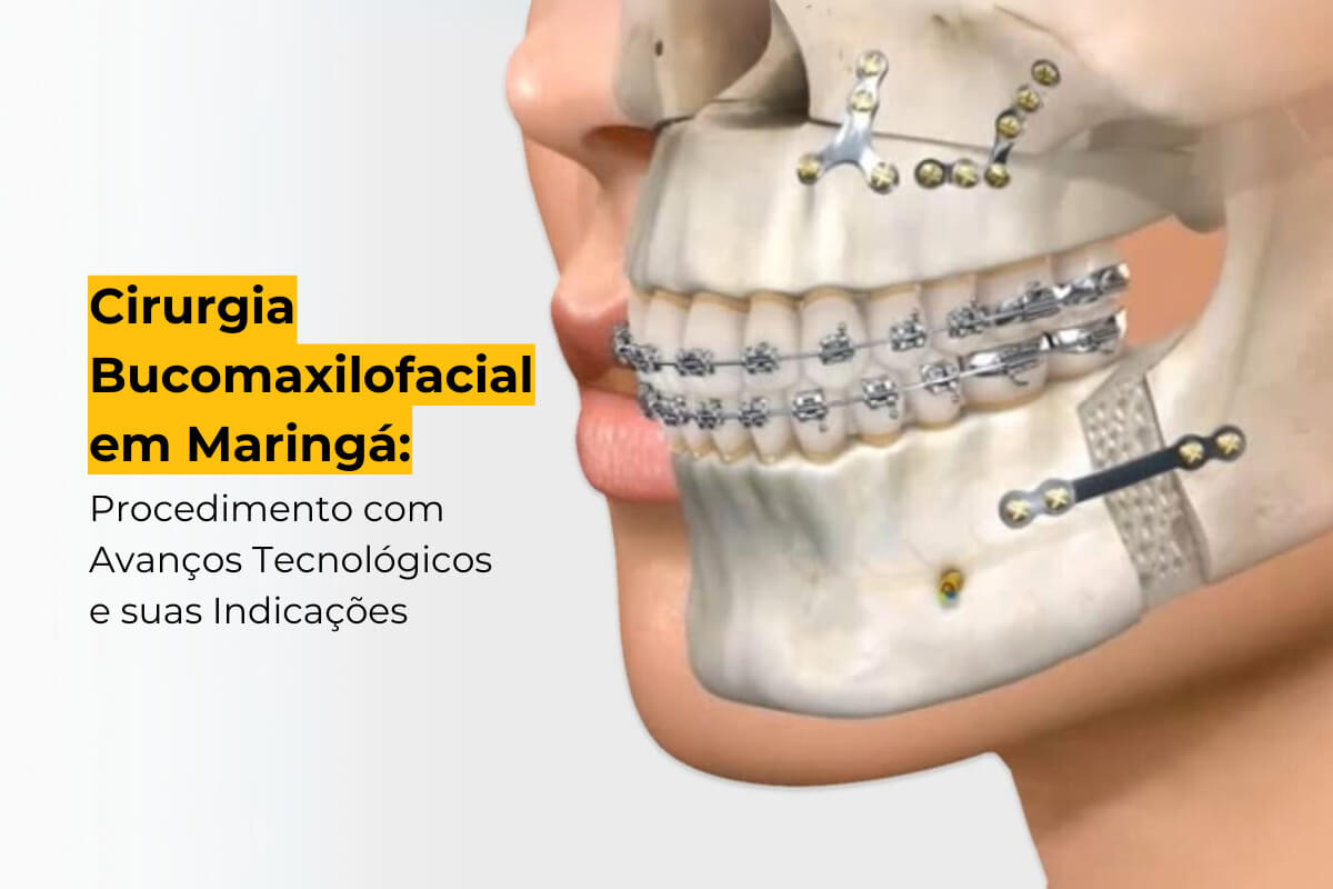 Cirurgia Bucomaxilofacial em Maringá: Procedimento com Avanços Tecnológicos e suas Indicações