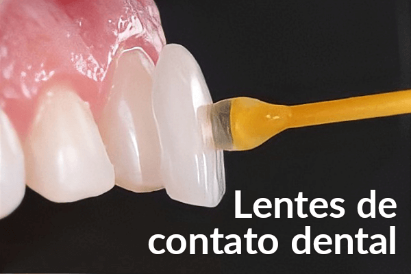 Lente de Contato Dental: Entenda o procedimento.