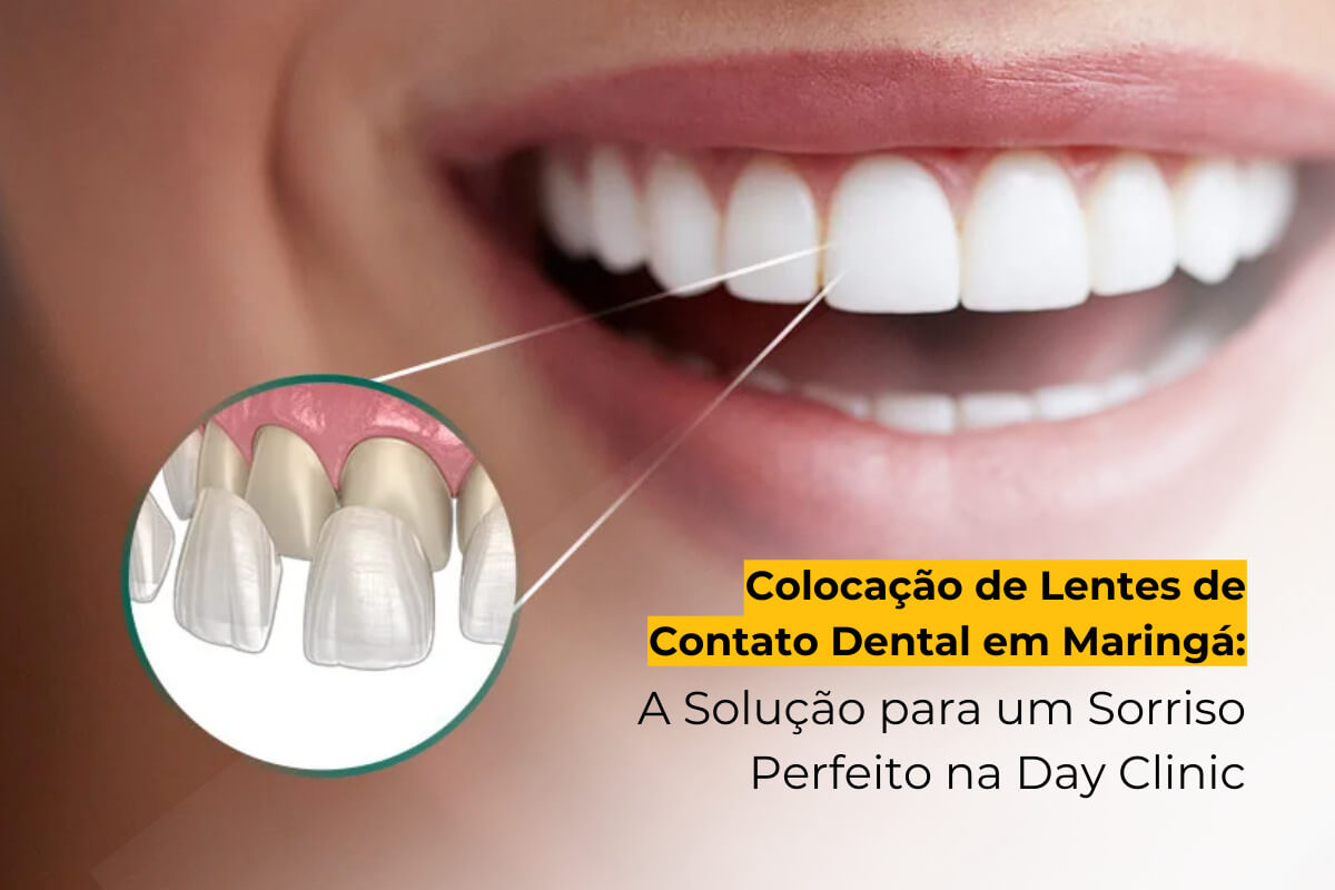 Colocação de Lentes de Contato Dental em Maringá: A Solução para um Sorriso Perfeito na Day Clinic