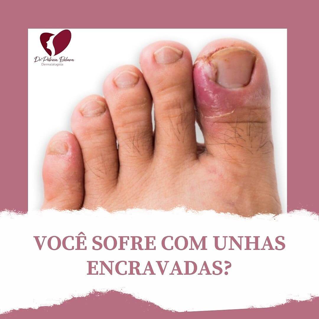 Você sofre com unhas encravadas