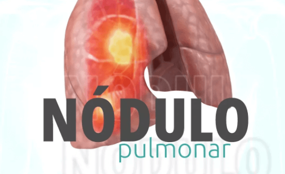 Nódulo Pulmonar