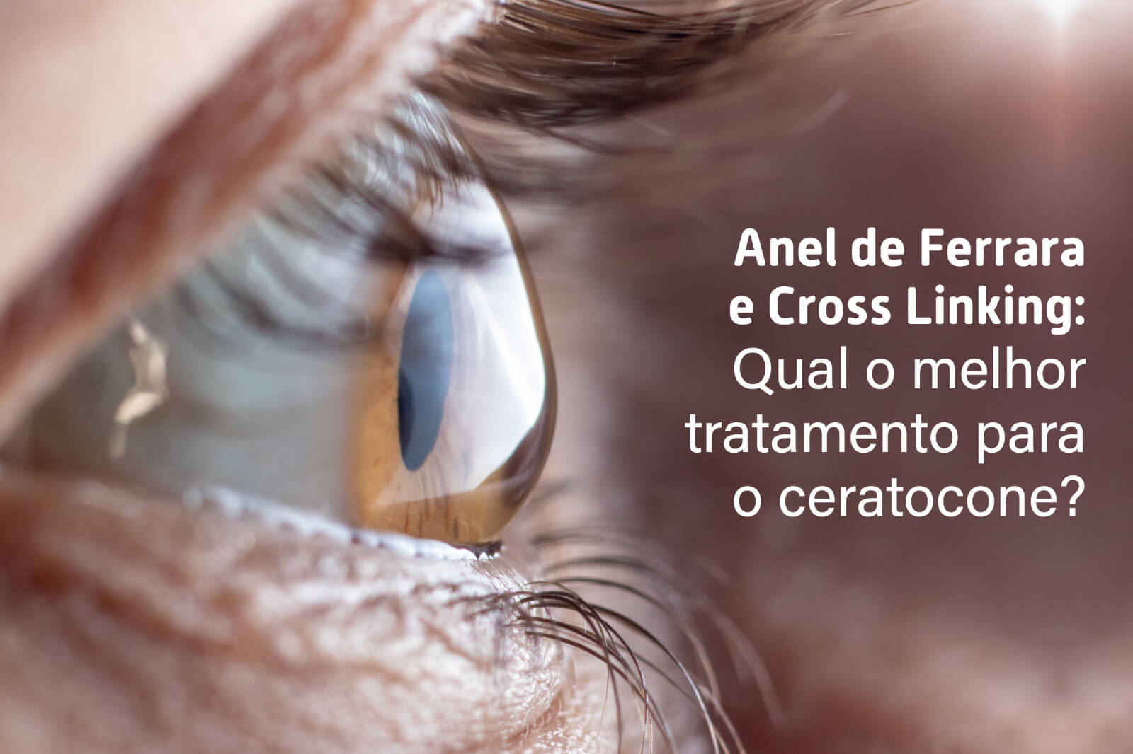 Anel de Ferrara e Cross-Linking: Qual o melhor tratamento para o ceratocone?