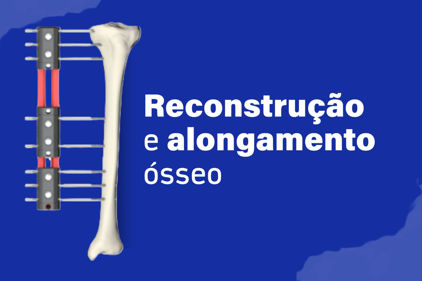 Reconstrução e alongamento ósseo