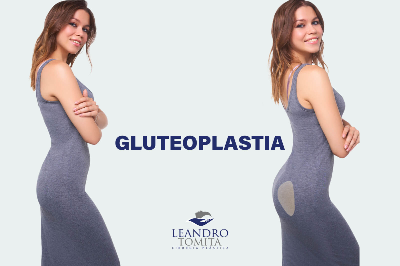 Gluteoplastia