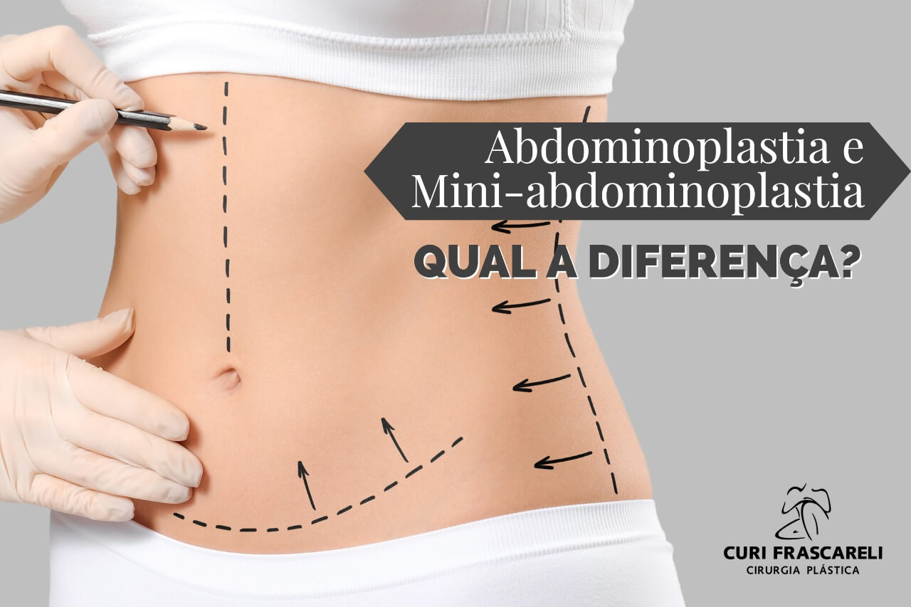 Abdominoplastia