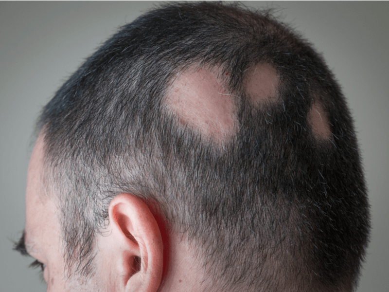 Alopecia Areata: Suas causas e seu tratamento