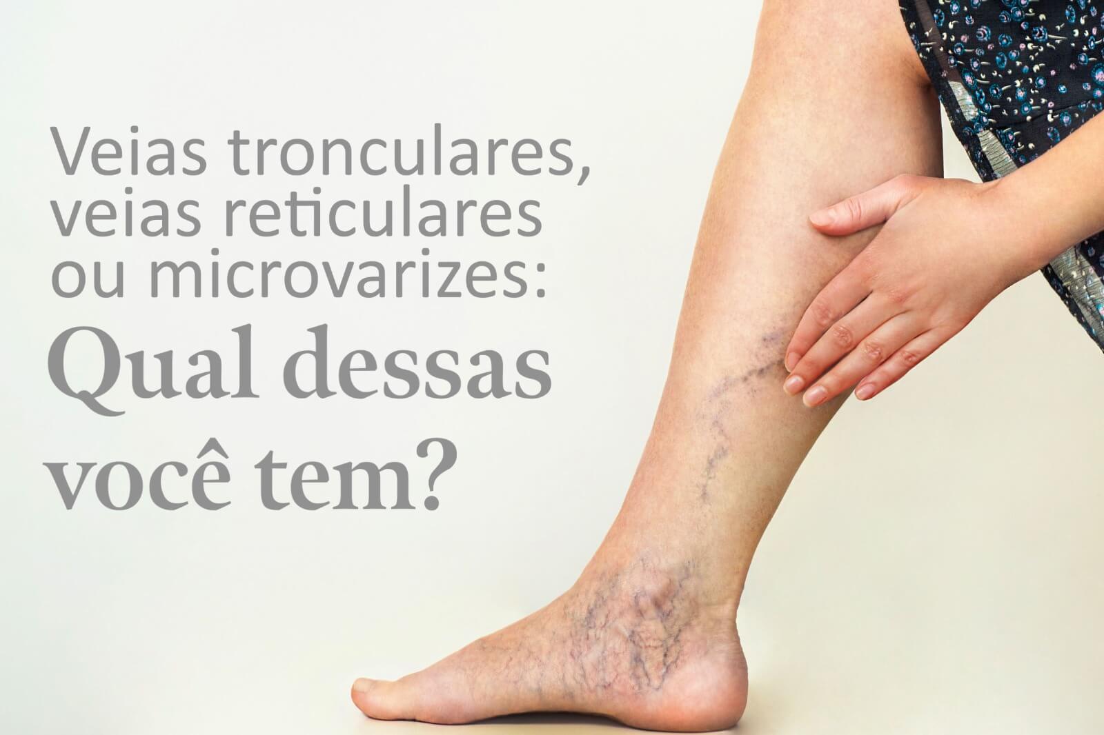 Veias tronculares, veias reticulares ou Microvarizes: Qual dessas você tem?