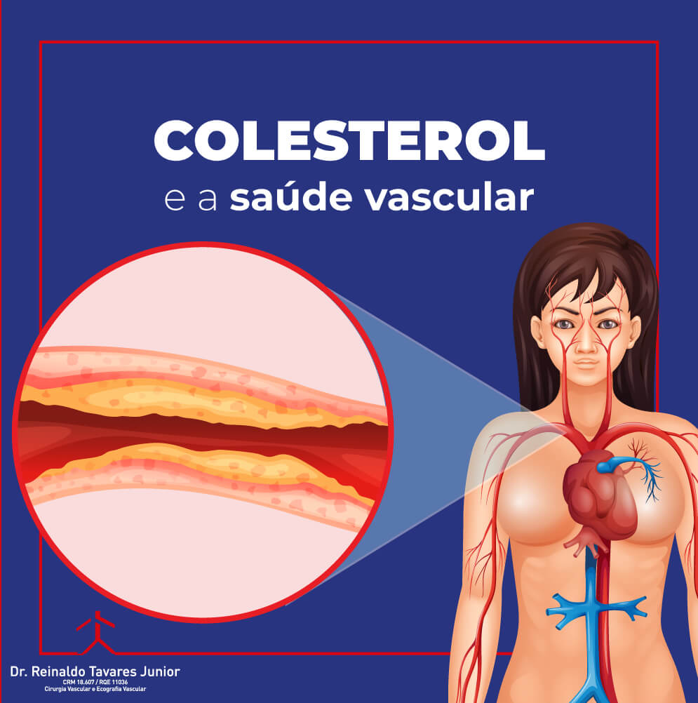 Colesterol e a Saúde Vascular