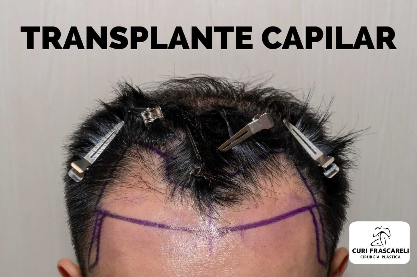 Transplante Capilar