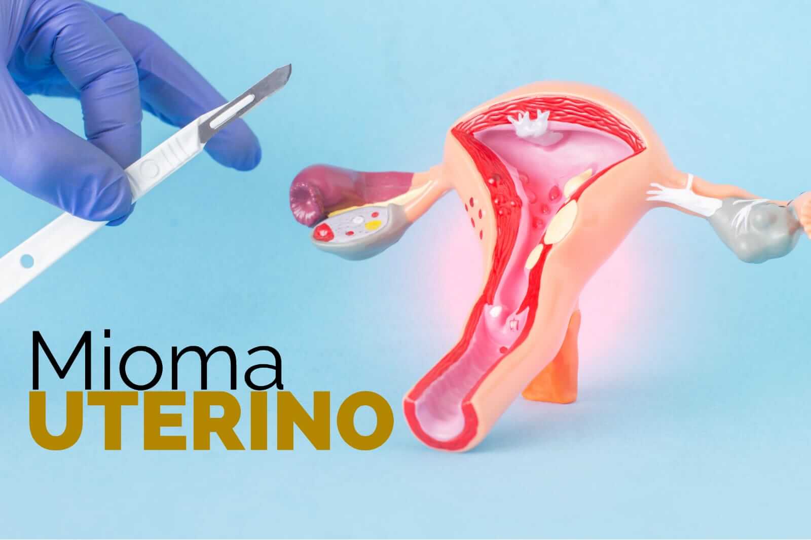 Mioma Uterino