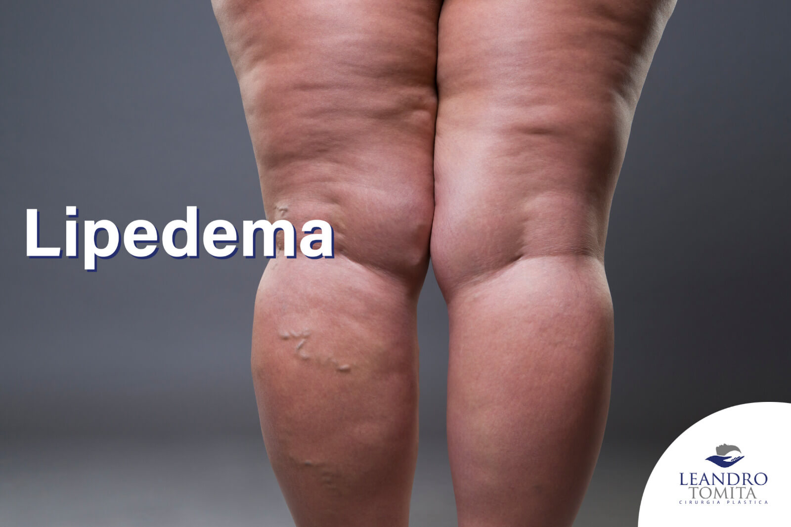 Lipedema