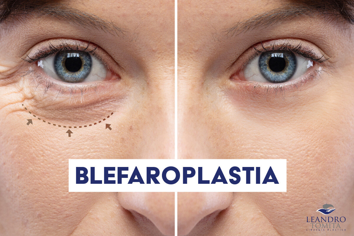 Blefaroplastia