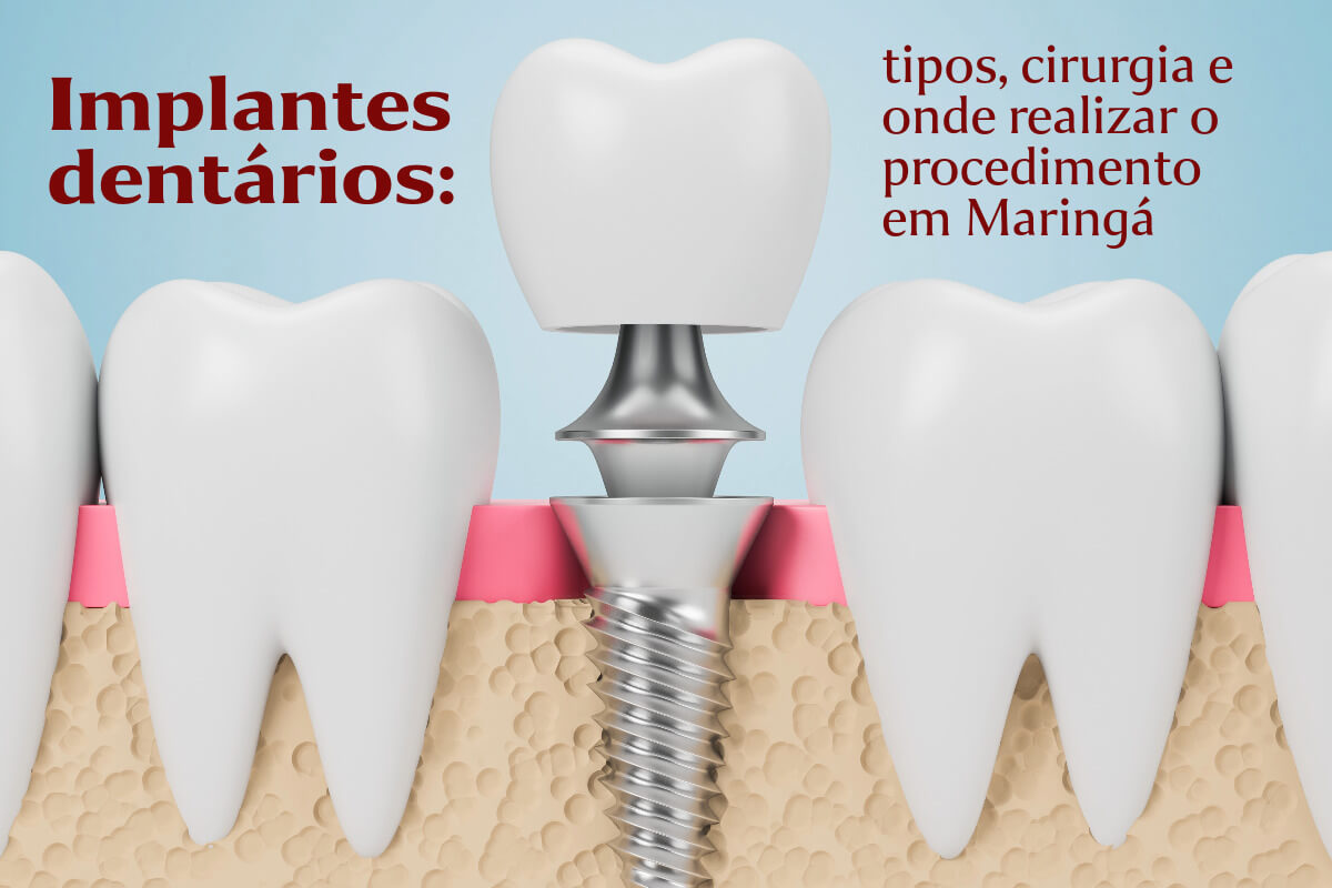 Implantes dentários: tipos, cirurgia e onde realizar o procedimento em Maringá