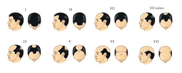 CONHEÇA OS 7 GRAUS DE CALVICIE (Escala Norwood-Hamilton)