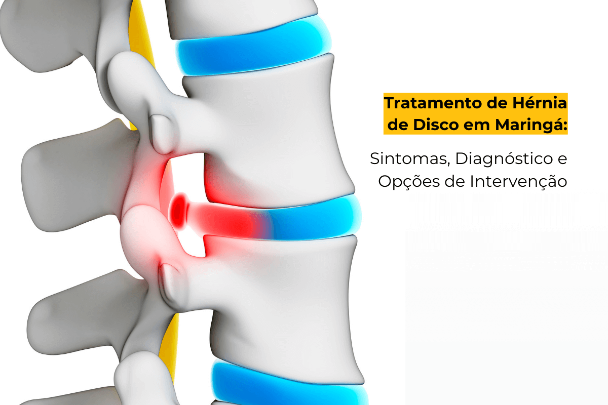 Tratamento de Hérnia de Disco em Maringá: Sintomas, Diagnóstico e Opções de Intervenção