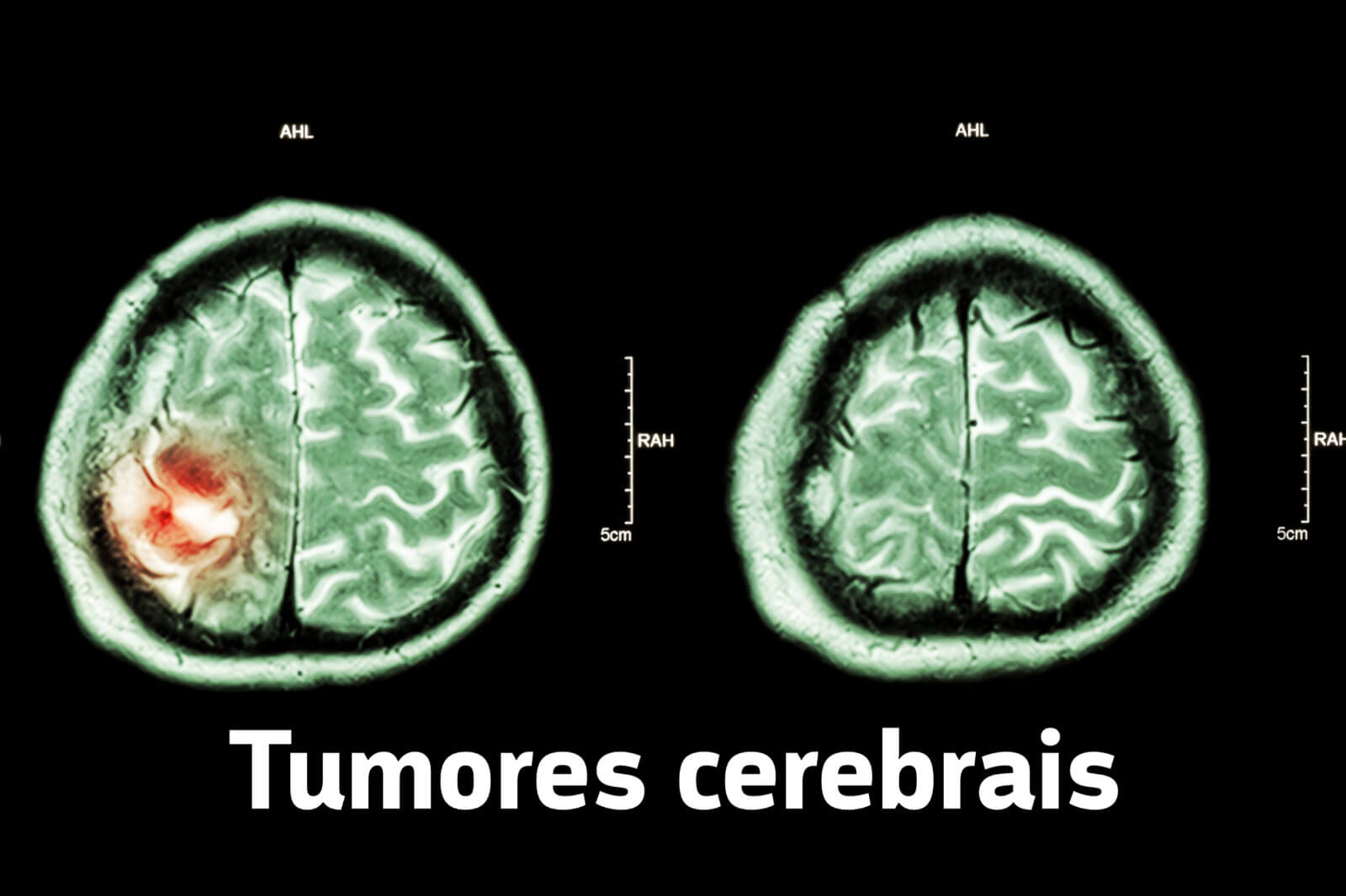 Tumores cerebrais