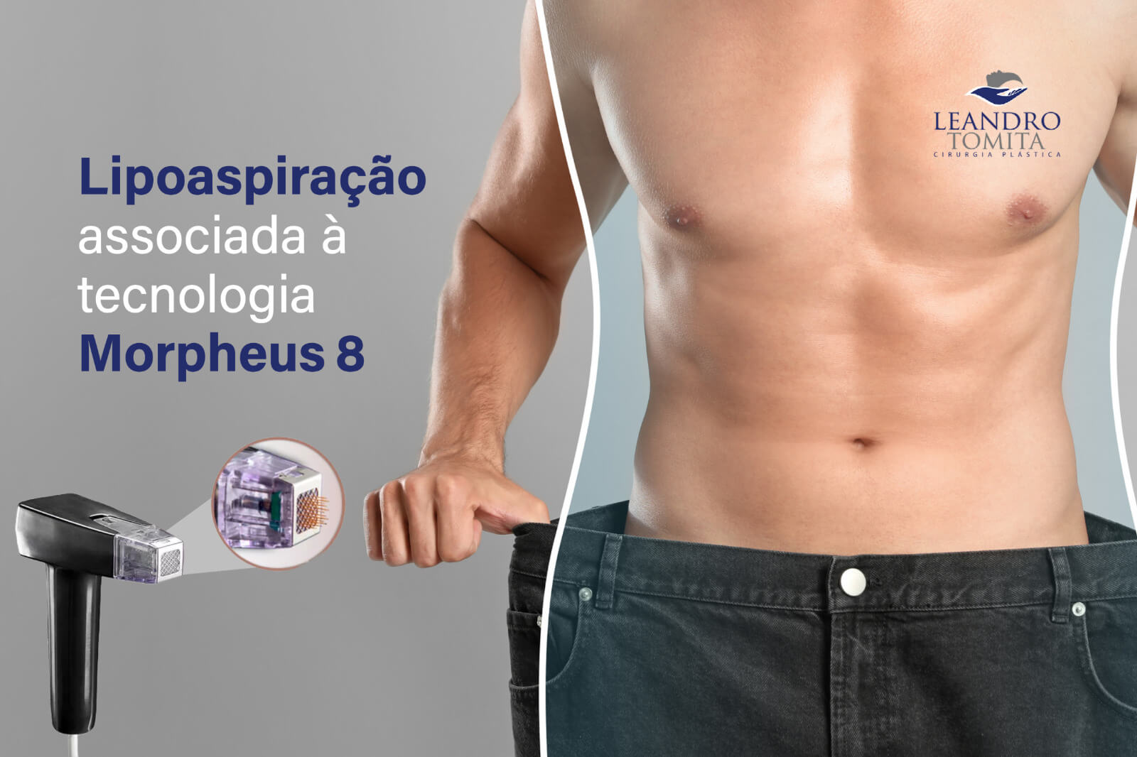 Lipoaspiração associada à tecnologia Morpheus 8