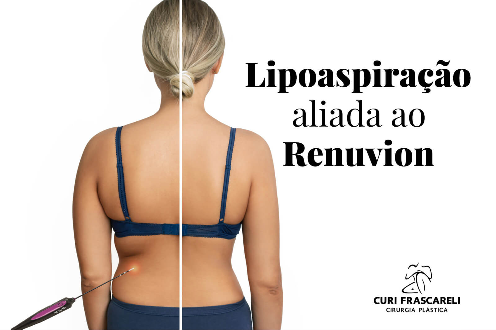 Lipoaspiração aliada ao Renuvion