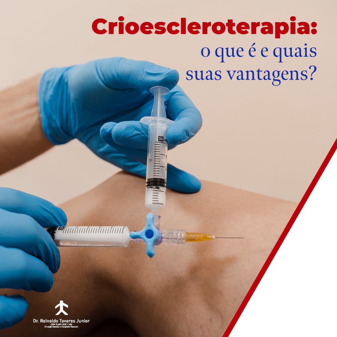 Crioescleroterapia: o que é e quais suas vantagens?