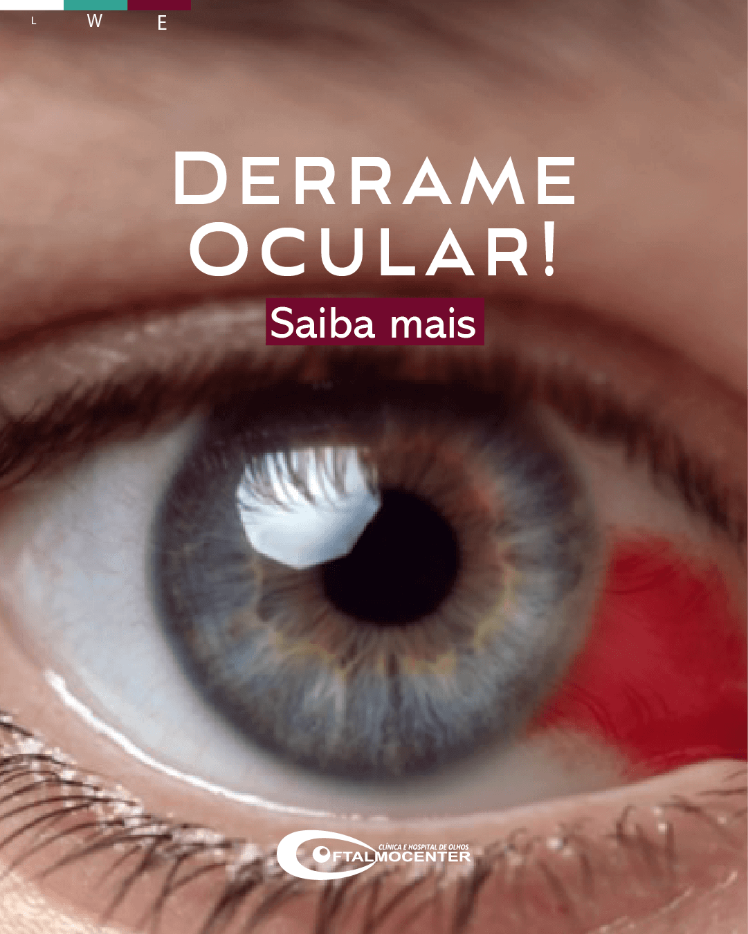 Derrame ocular