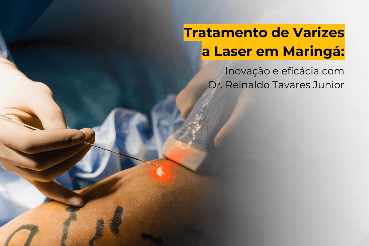 Tratamento de Varizes a Laser em Maringá: Inovação e Eficácia com Dr. Reinaldo Tavares Junior