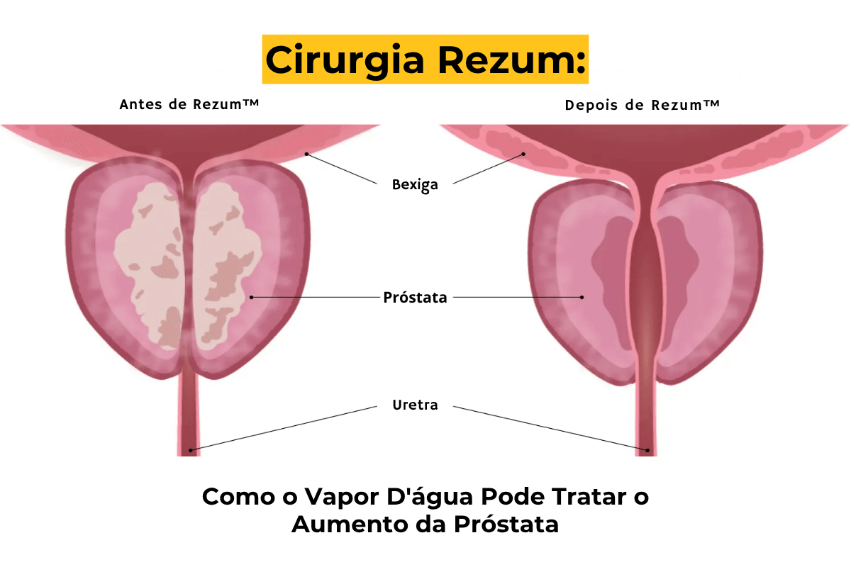 Cirurgia Rezum em Maringá: Como o Vapor D'água Pode Tratar o Aumento da Próstata