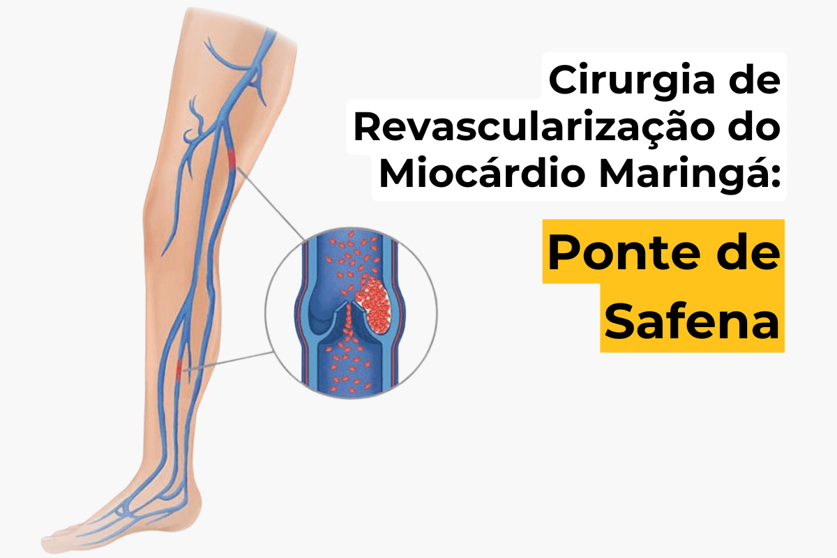 Cirurgia de Revascularização do Miocárdio Maringá: Ponte de Safena