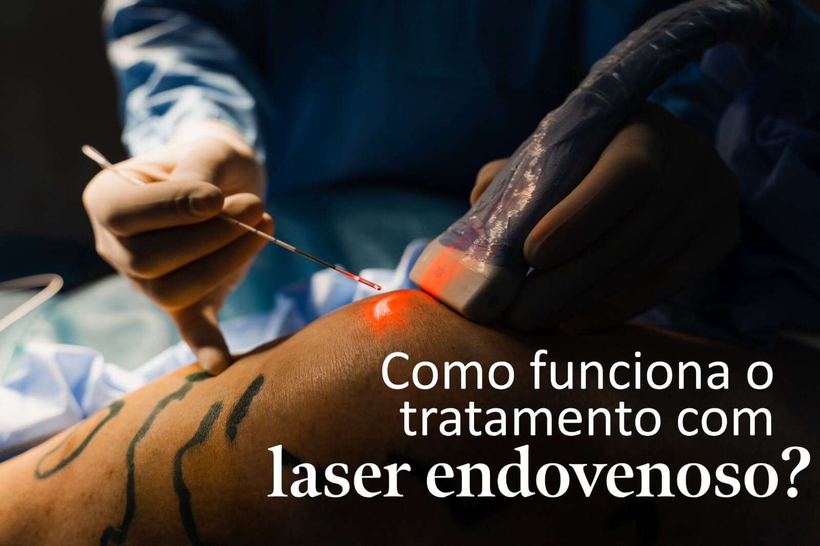 Como funciona o tratamento com laser endovenoso?