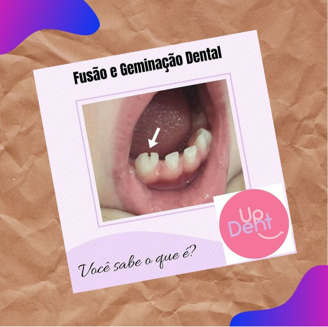 Fusão e Geminação Dental