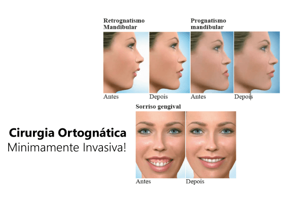 Prognatismo Mandibular o Clase 3 » Cirugía Ortognática - Instituto