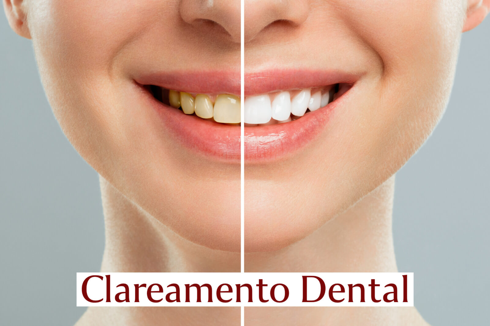 Clareamento dental