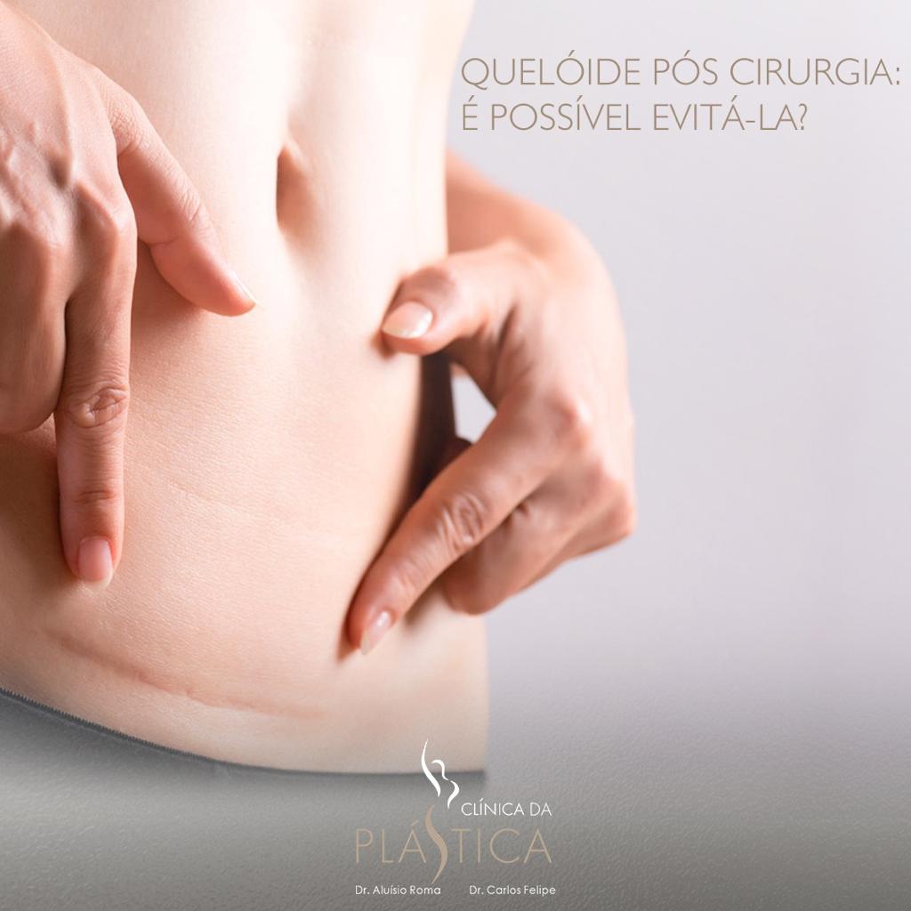 Quelóide pós cirurgia: é possível evitá-la?