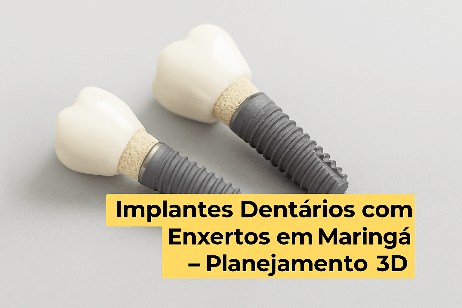 Implantes Dentários com Enxertos em Maringá — Planejamento 3D