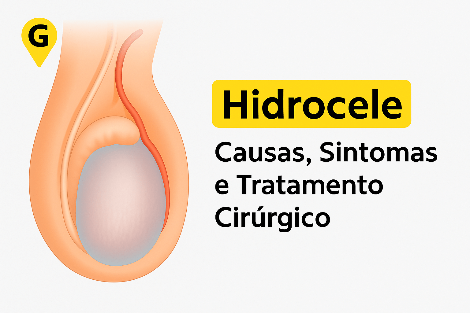 Hidrocele em Umuarama: Causas, Sintomas e Tratamento Cirúrgico