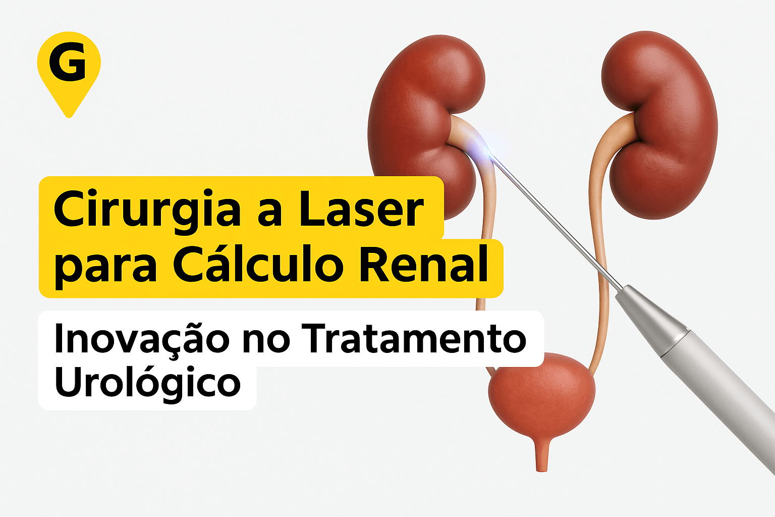 Cirurgia a Laser para Cálculo Renal em Maringá: Inovação no Tratamento Urológico