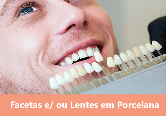 Facetas e/ ou Lentes em Porcelana