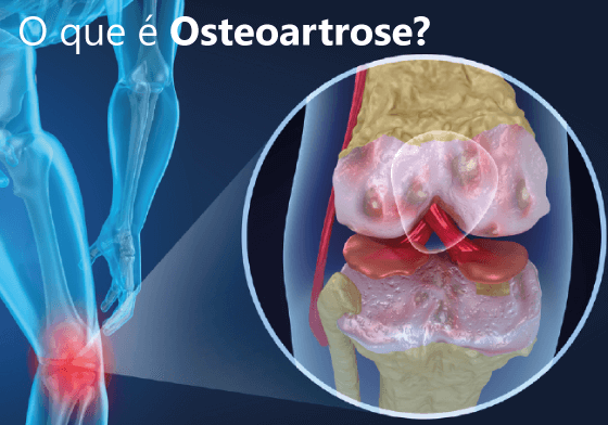 O que é Osteoartrose?
