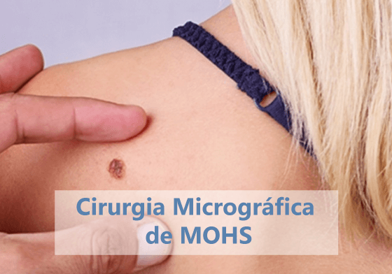 Cirurgia Micrográfica de MOHS