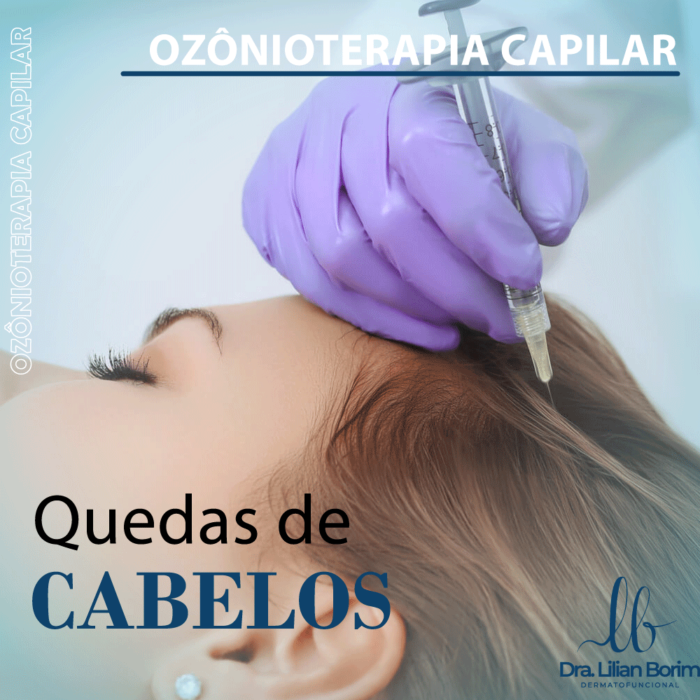 Queda de cabelo? Ozonioterapia!!! 