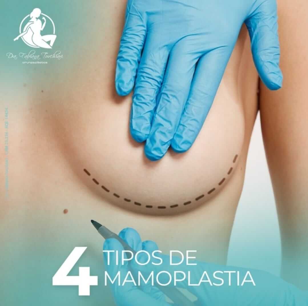 Tipos de mamoplastia