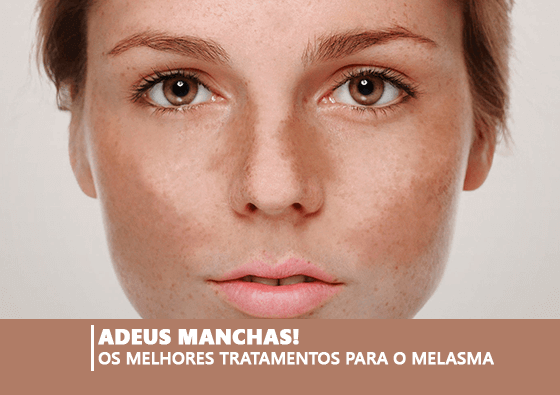 ADEUS MANCHAS! OS MELHORES TRATAMENTOS PARA O MELASMA