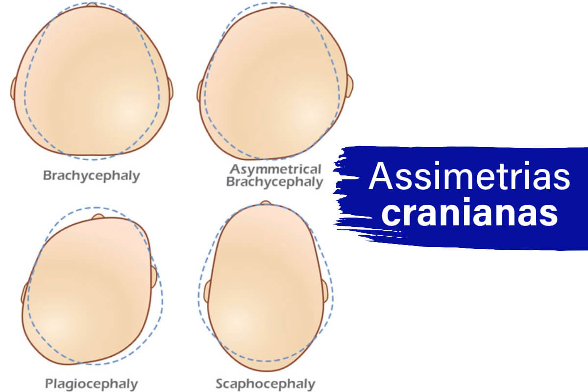 Assimetrias cranianas