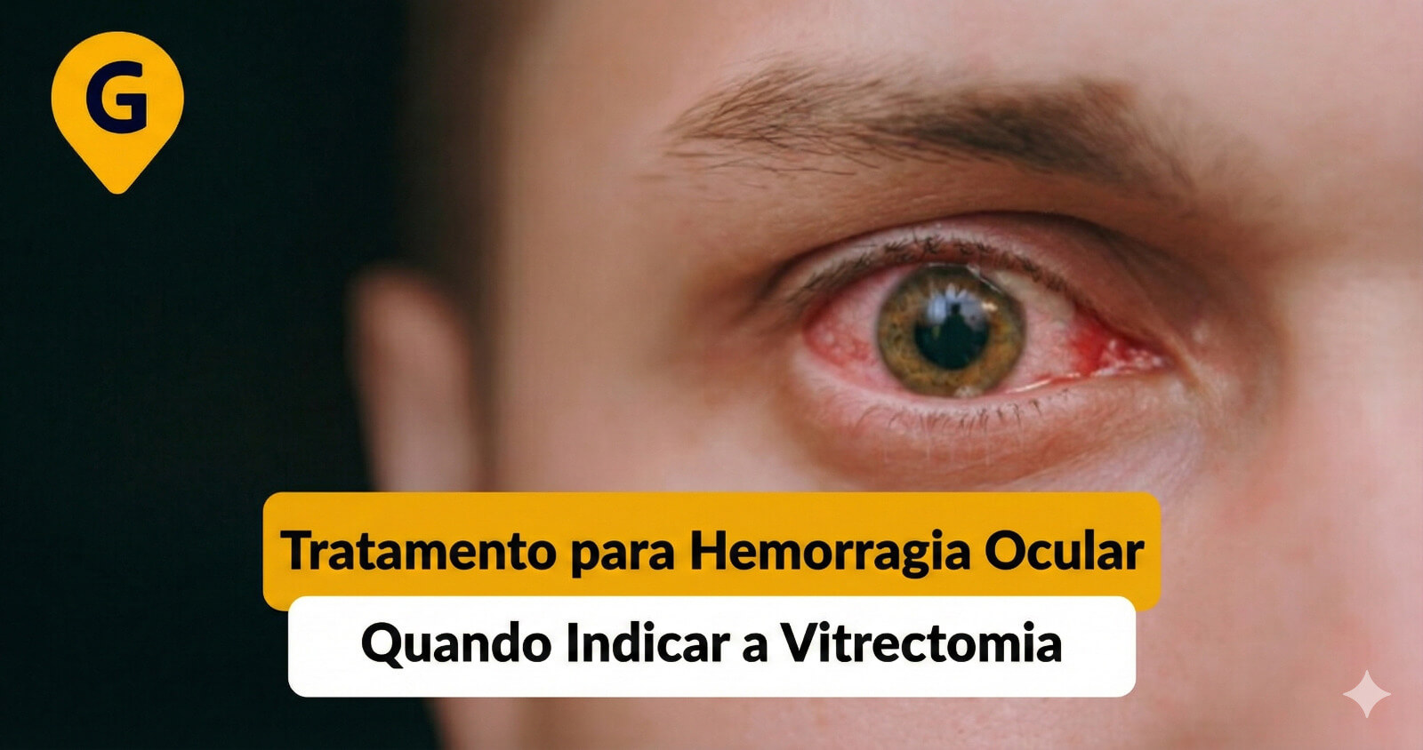 Tratamento para Hemorragia Ocular em Maringá: Quando Indicar a Vitrectomia